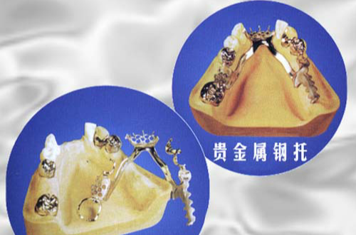 高贵金属铸造合金(高贵金属铸造合金的定义是)